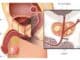 prostate