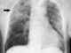 Pneumonia