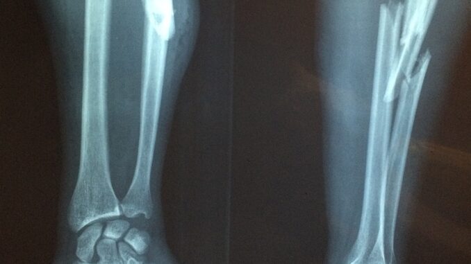 fracture bone 2333164 1280