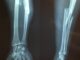 fracture bone 2333164 1280